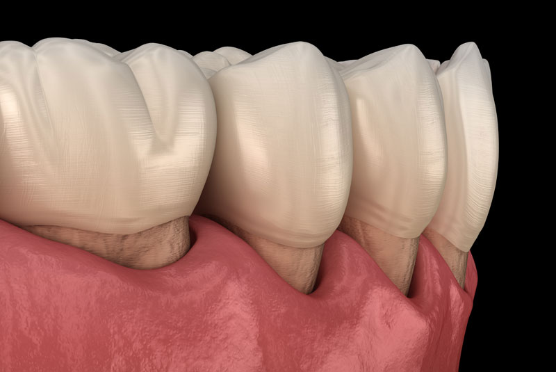 gum recession graphic