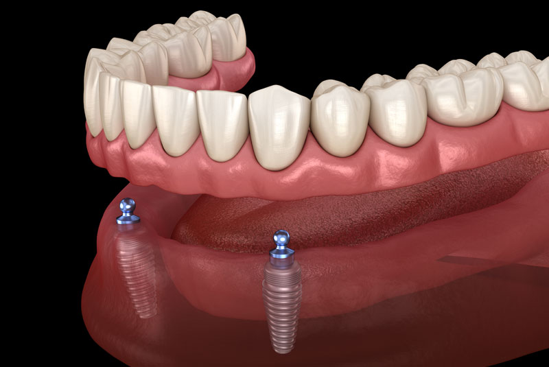 implant supported denture model