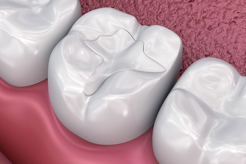 composite fillings