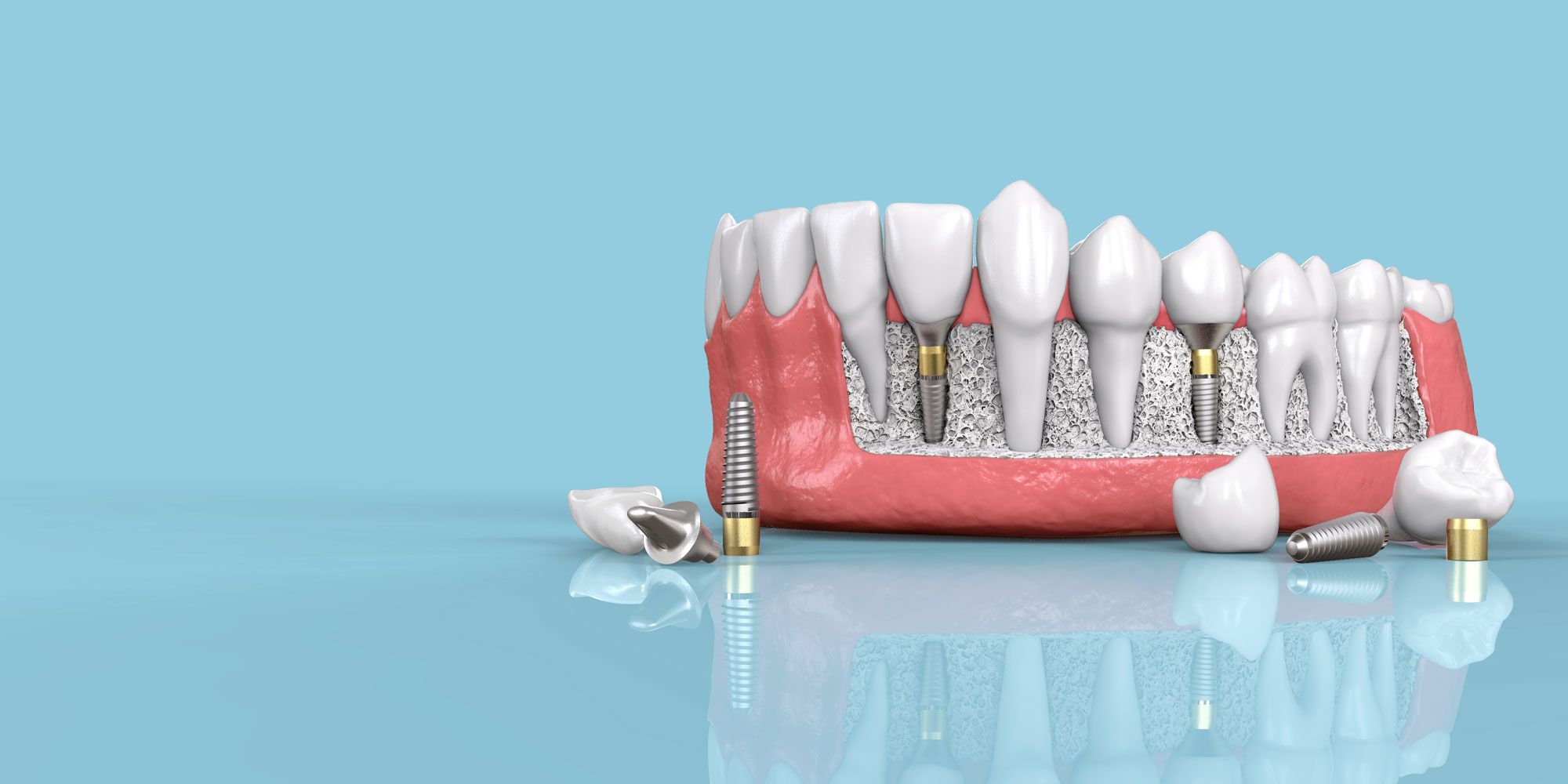 bone graft model