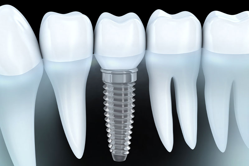 dental implant model