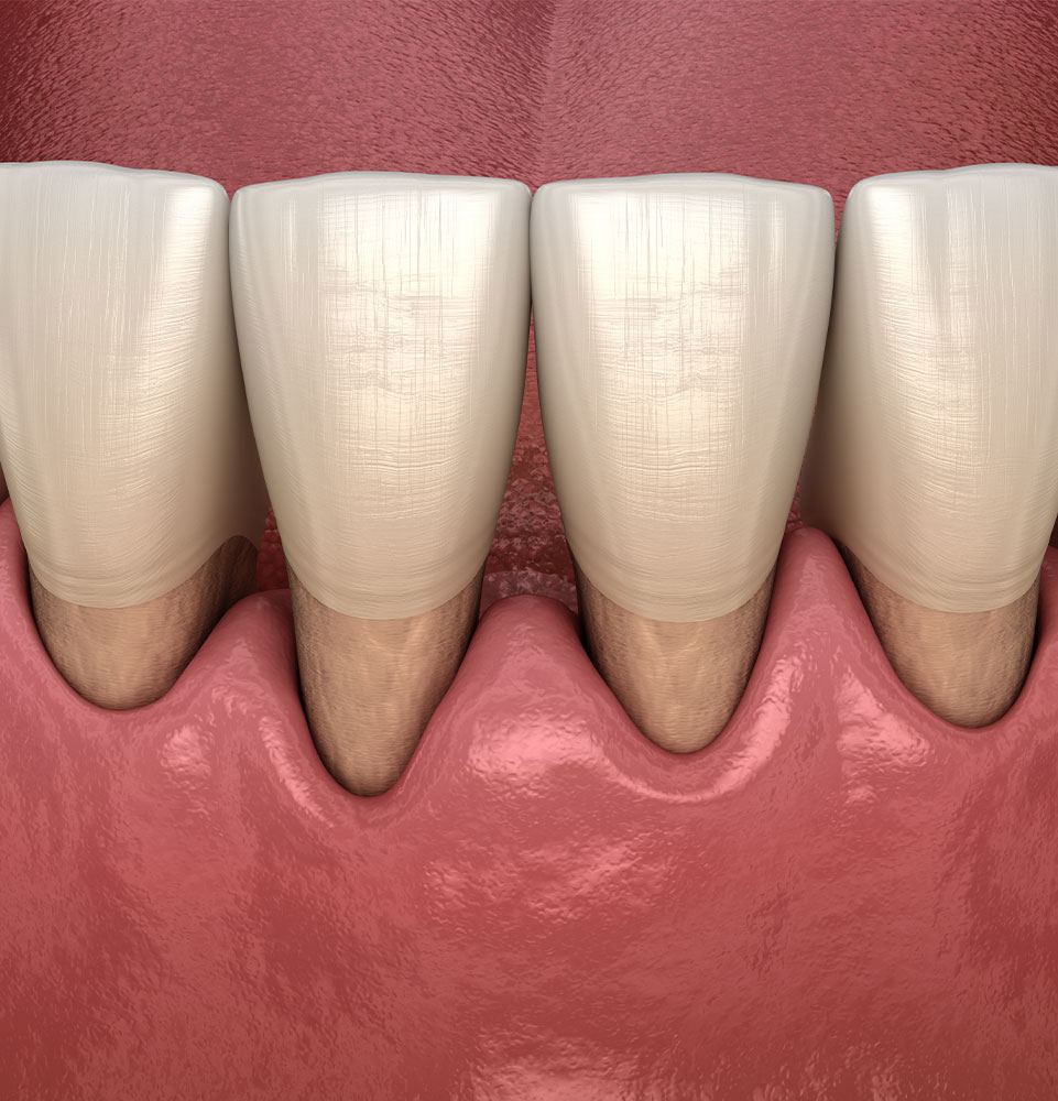 gum recession graphic